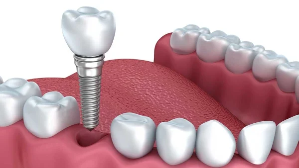 Dental implant in Ahmedabad