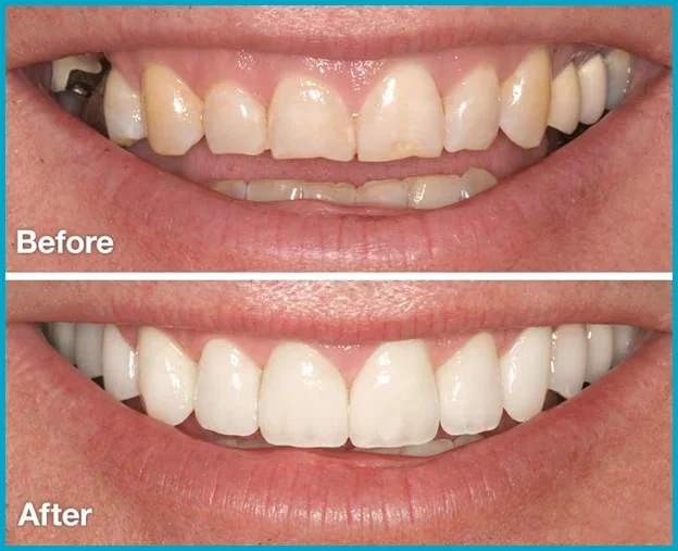 Smile Design Treatment