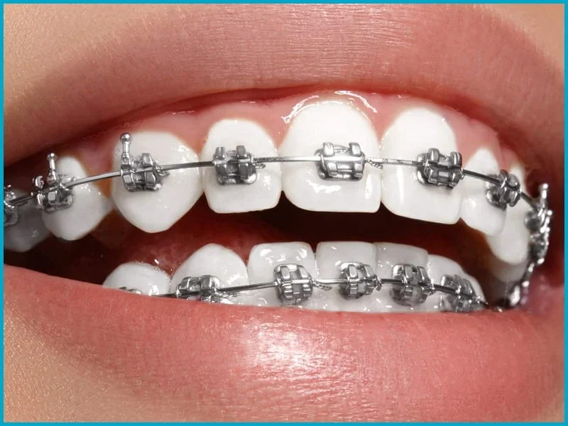 dental braces