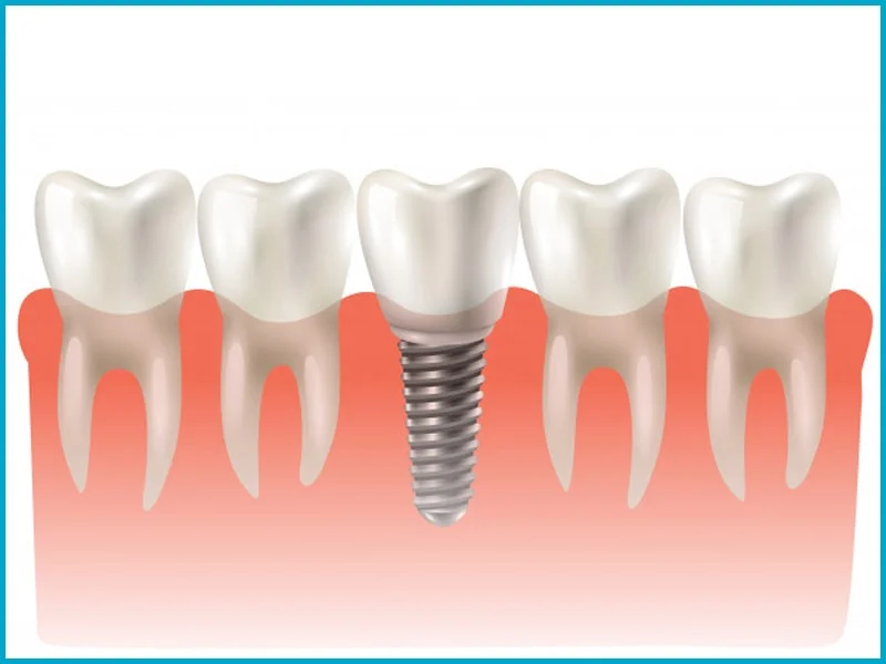 Dental Implants