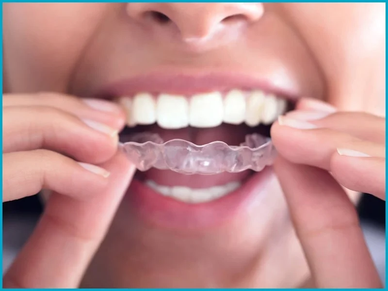 Invisalign