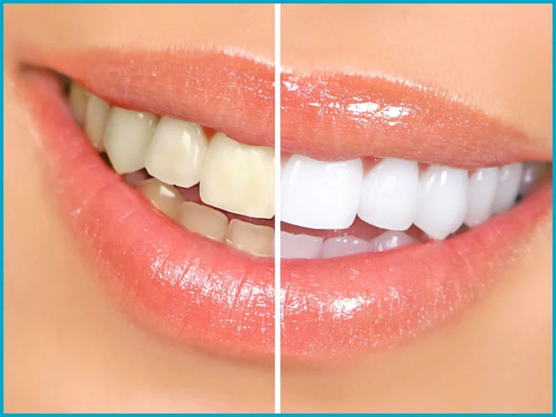 Teeth Whitening